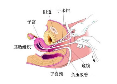 做人流 首选华阳红房子医院